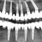 Case Studies Εμφυτεύματα | Dental Implants